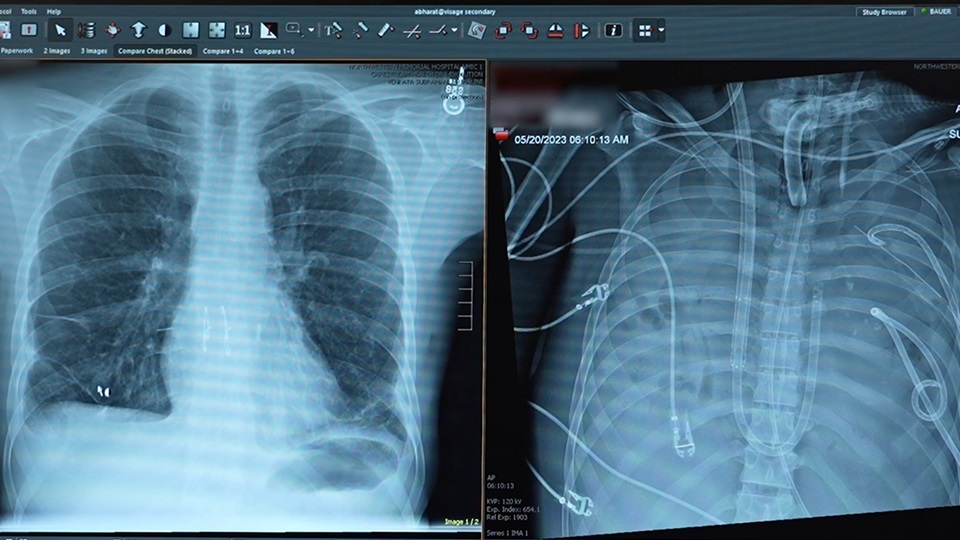X-Rays of a patient who received a double lung transplant.