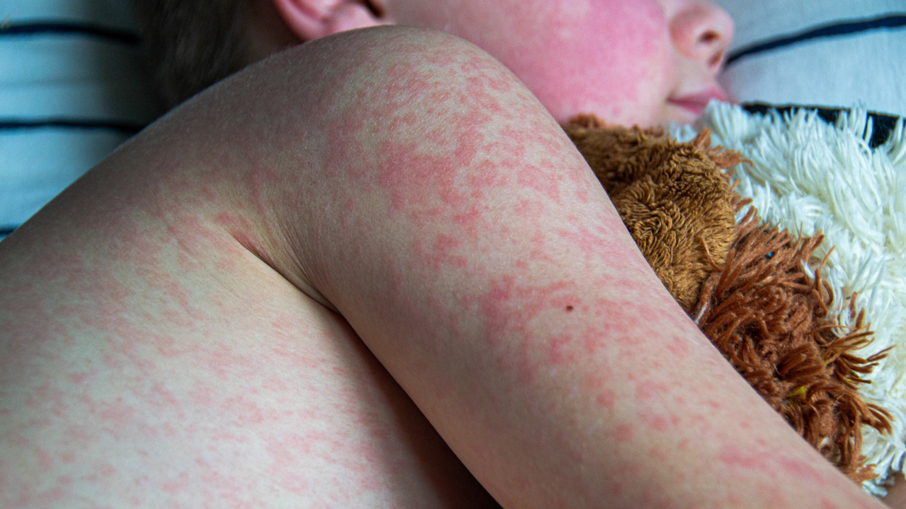 Red measles rash all over the arm, side and cheek of a child lying on his side in bed.