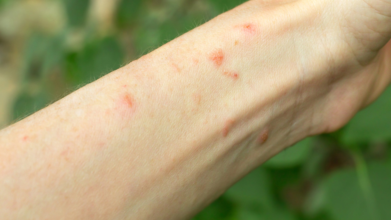 Poison ivy rash on an arm.