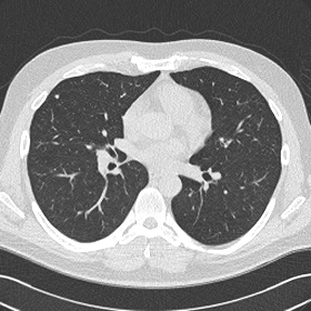 What Are Lung Nodules Northwestern Medicine
