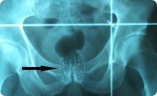 Prostate_Seed_Implant_X-ray
