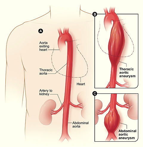 symptoms-of-aortic-aneurysm