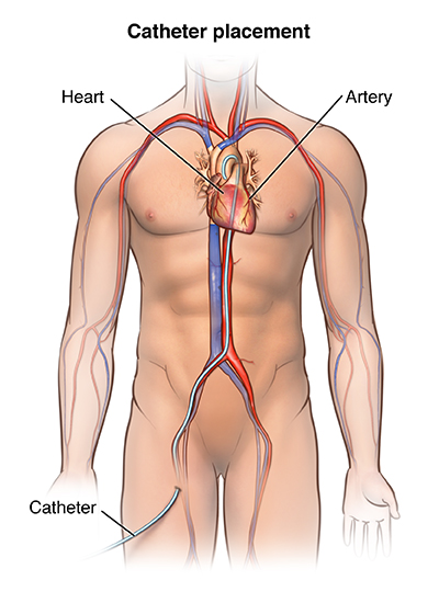 Catheter placement