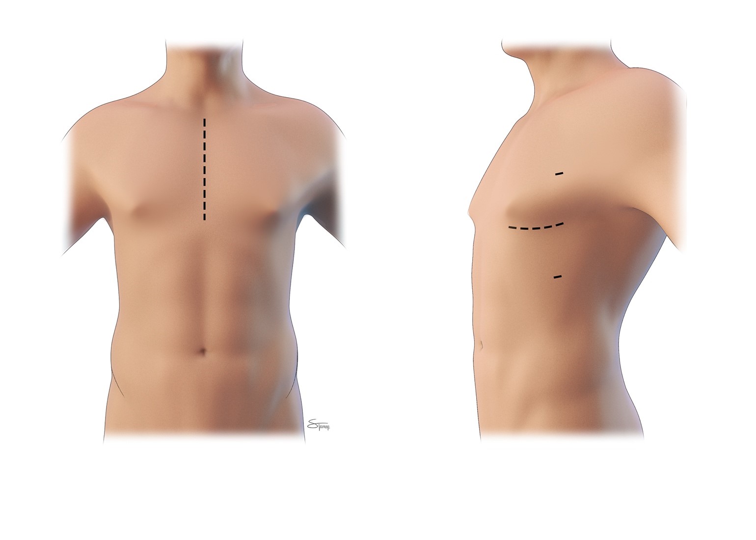 Minimally invasive incisions for a coronary artery bypass graft