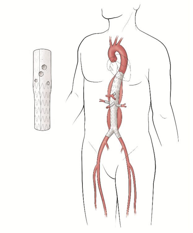 Fenestrated Endovascular Aortic Repair (FEVAR) or Branched Endovascular Aortic Repair (BEVAR) 