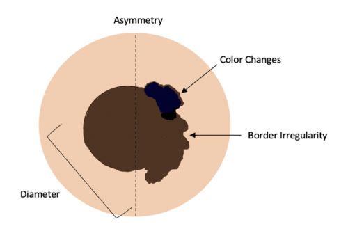 moles that change color