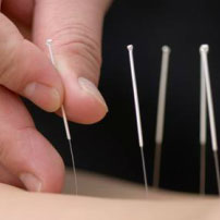 Acupuncture treatment being done on a patient