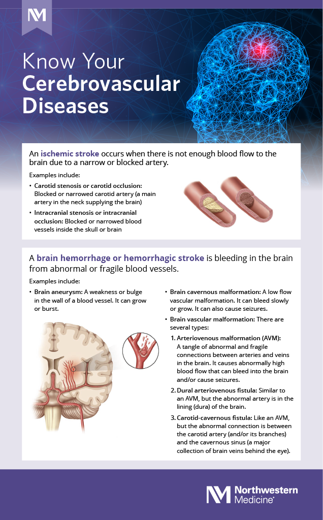 Understanding Stroke And Cerebrovascular Disease Northwestern Medicine