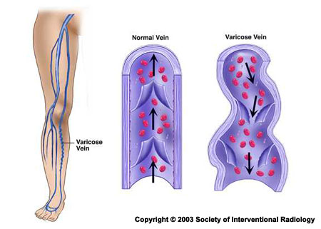 northwestern-medicine-varicose-vein