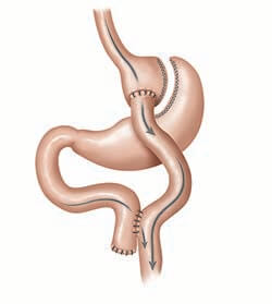 Roux-en-Y Gastric Bypass Surgery illustration
