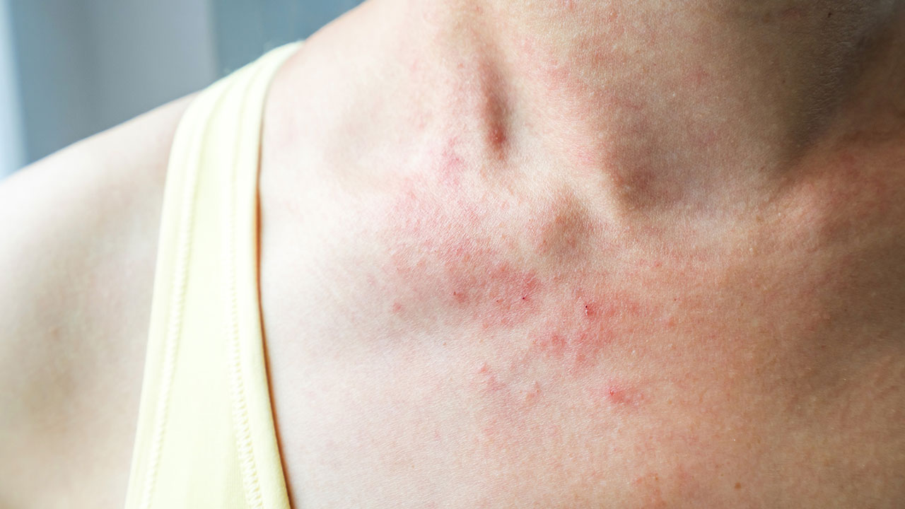Cercarial Dermatitis: Symptoms, Treatment, and More