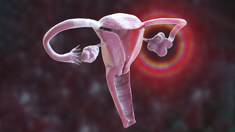 Computer illustration of reproductive system with enlarge ovaries highlighted.