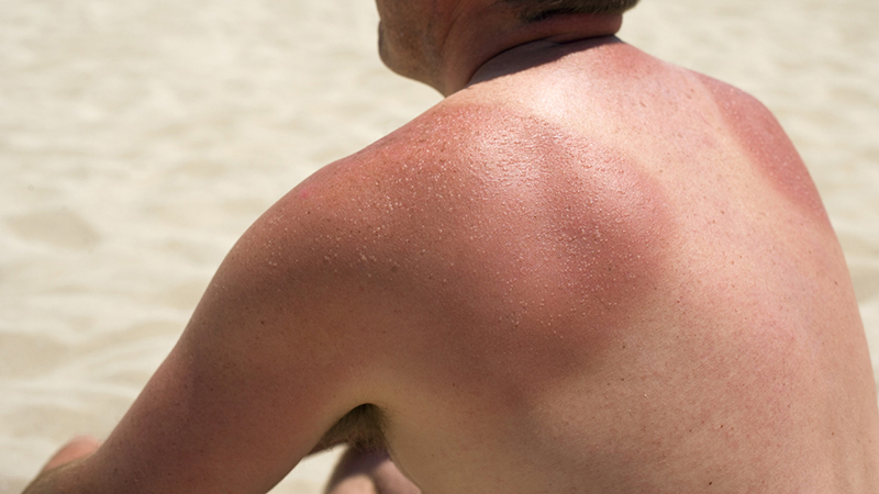 When Should I See a Physician for Sunburn?