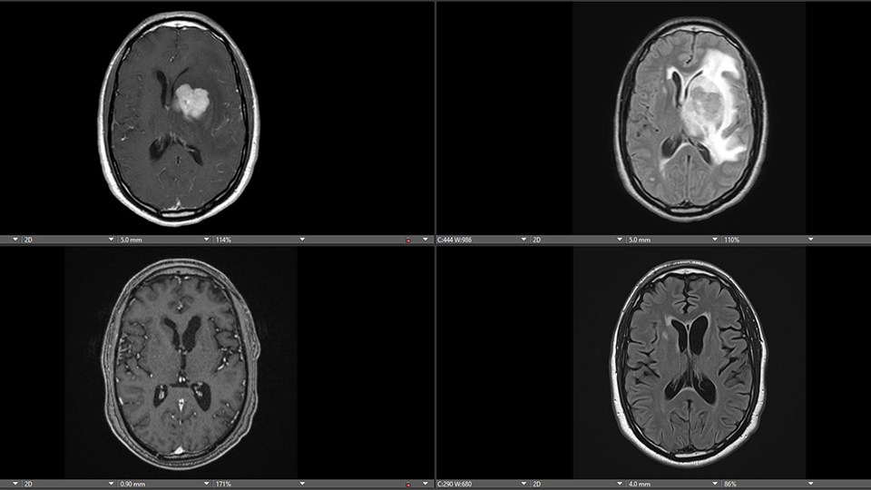 Imaging of a brain tumor